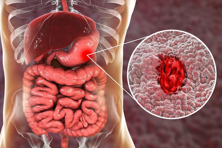 Ulcer Relief